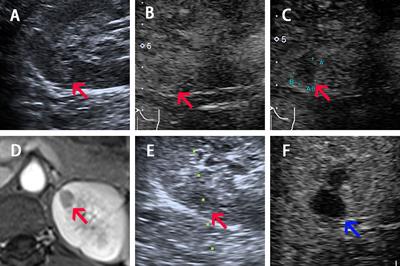 The Role of Real-Time Contrast-Enhanced Ultrasound in Guiding Radiofrequency Ablation of Reninoma: Case Report and Literature Review